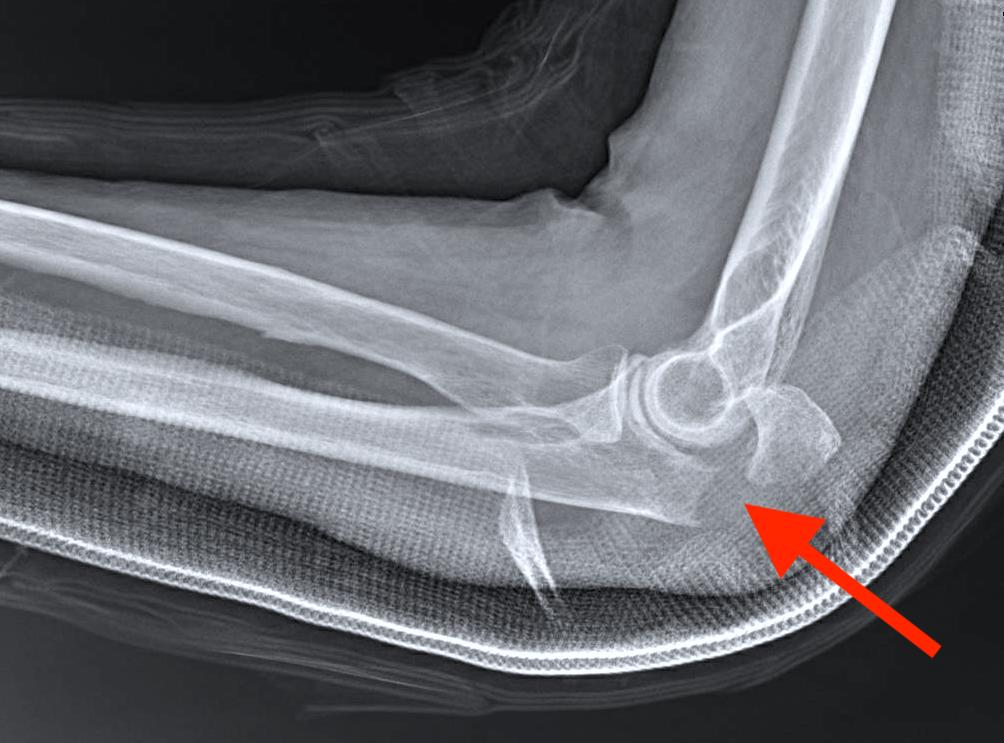 L’articolazione del gomito è composta da tre ossa: omero (osso del braccio) ulna (osso dell’avambraccio) radio (seconda osso dell’avambraccio) Questa specialissima articolazione del nostro corpo è tenuta insieme da legamenti, muscoli e tendini. Si flette e si estende come una cerniera, ma è importante anche per la rotazione dell’avambraccio. E’ un articolazione molto importante nella vita di tutti i giorni Che cosa si “rompe”? La frattura dell’olecrano è una rottura della parte iniziale dell’osso ulnare, quello che sporge quando pieghiamo il gomito. Questo tipo di frattura è più comune di quanto si pensi e di solito si verifica: isolata all’ulna complessa con frattura del radio e dell’omero Immagini e trattamento Gomito frattura olecrano Gomito frattura olecrano Gomito frattura olecrano Gomito frattura olecrano Gomito frattura olecrano trattata con placca e viti Gomito frattura olecrano Gomito frattura olecrano Gomito frattura olecrano Gomito frattura olecrano